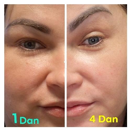 rezultati-pre-posle-serum-za-lice-sa-probiotikom-10012606-rossen