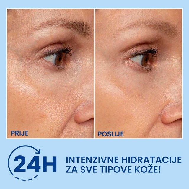 HA-FILLER-PRIJE-POSLE