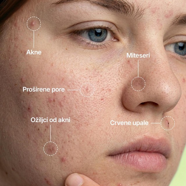 BYE-BYE-ACNE----LICE