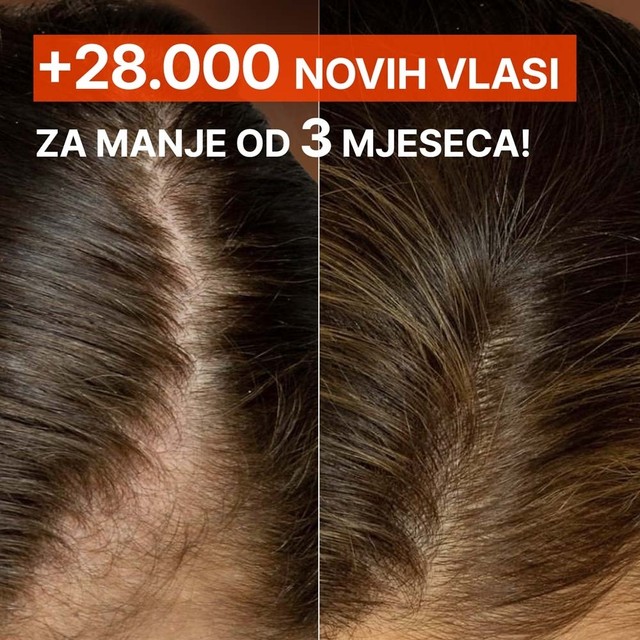 rossen-1001234-rezultati-nakon-3-mjeseca-kosa-ampula